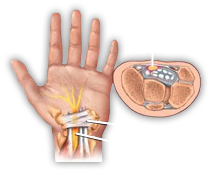 carpal-tunnel